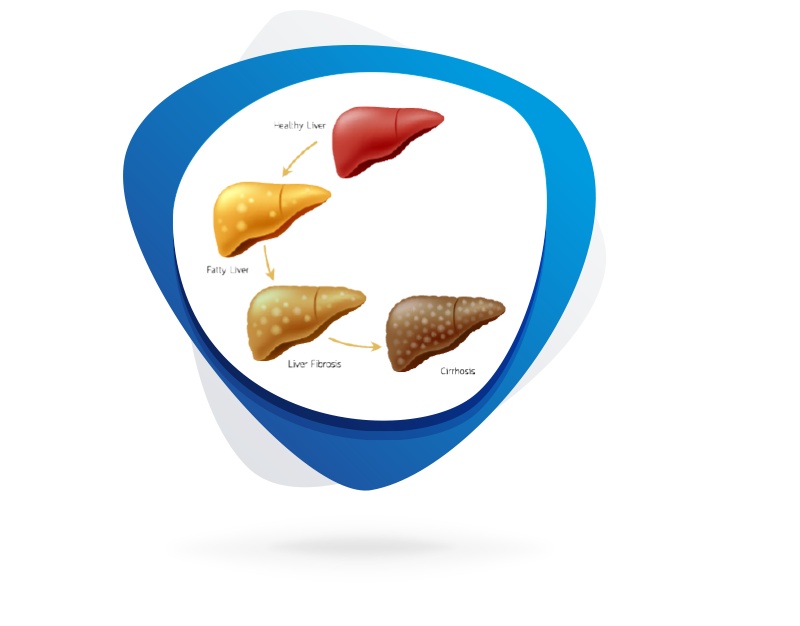 NAFLD / NASH