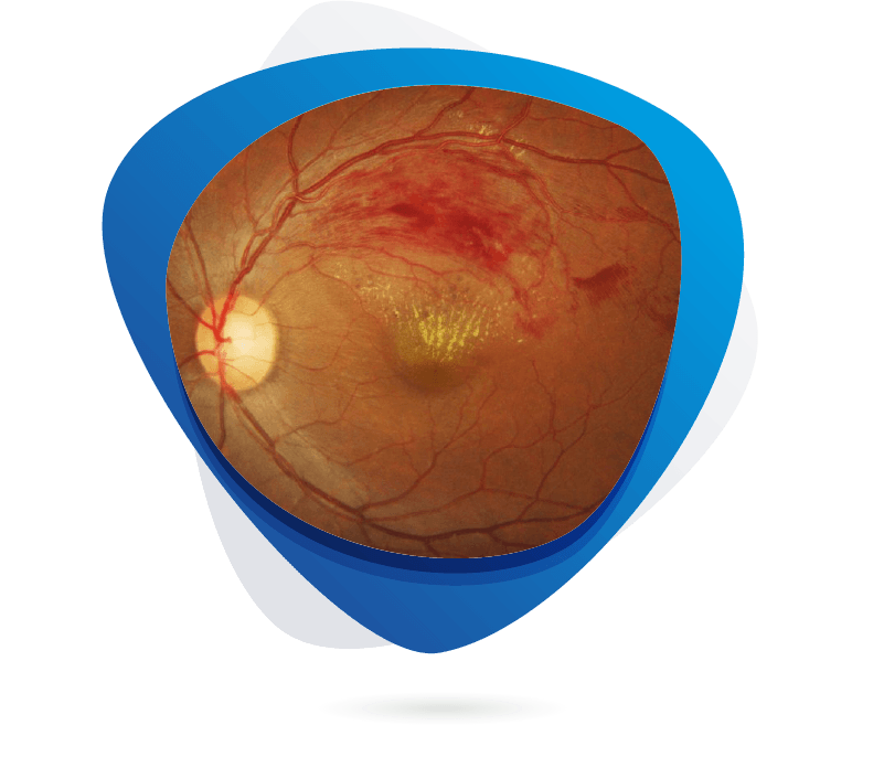 Retinal Vein Occlusion