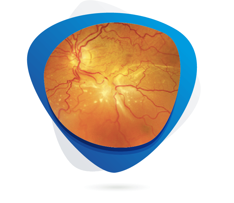 Proliferative Vitreoretinopathy (PVR)