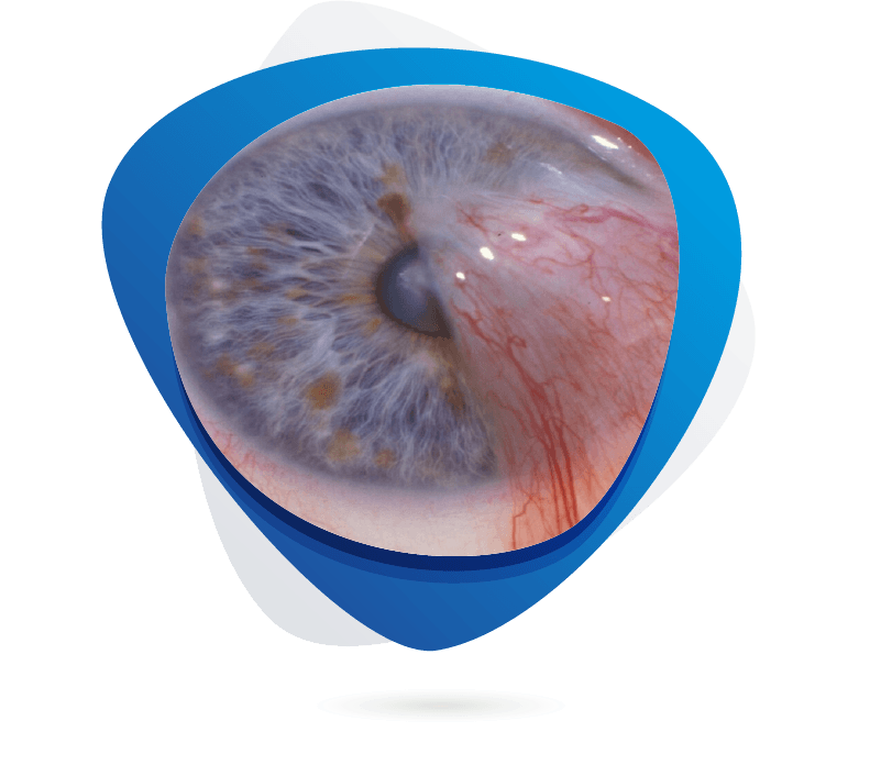 Pterygium